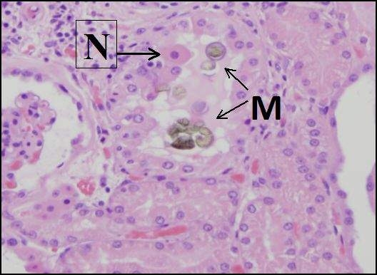 La precipitación de cristales de melamina-ácido cianúrico (M) causa daño mecánico a las células en los túbulos distales de un riñón canino. Una célula necrótica (muerta) (N) se ha desprendido de la membrana basal. La contaminación por melamina de alimentos para mascotas causó lesión renal a cientos de perros y gatos en 2007. (Cortesía de la Universidad de California, Davis Patología Anatómica.)