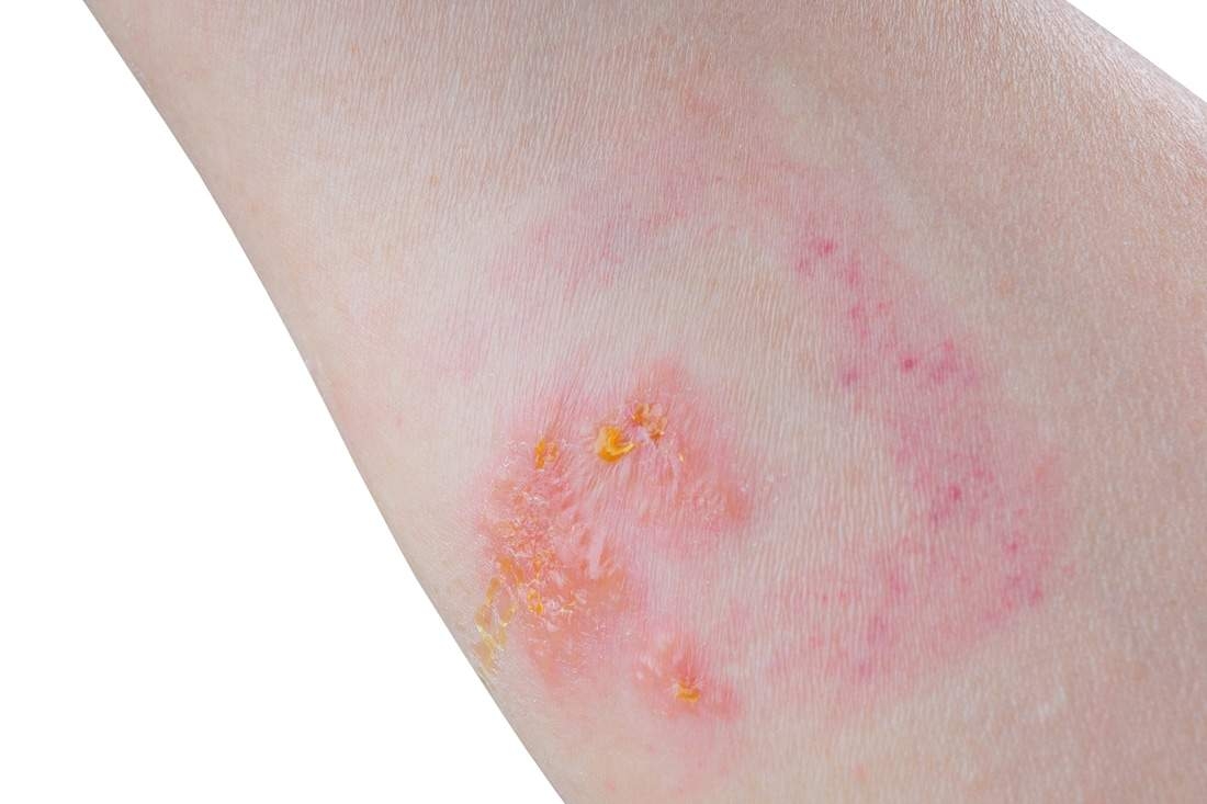 Skin contact with leaves of poison ivy can result in a blistering rash.